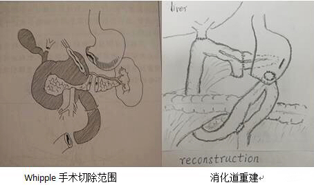为了让患者更加直观的明白Whipple手术方式，刘竞还手绘了图示，为患者答疑解惑。