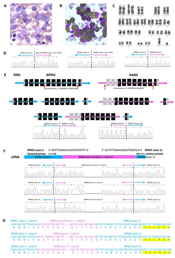 NPM1-RARA-NPM1融合基因的急性早幼粒细胞白血病细胞形态和基因序列解析