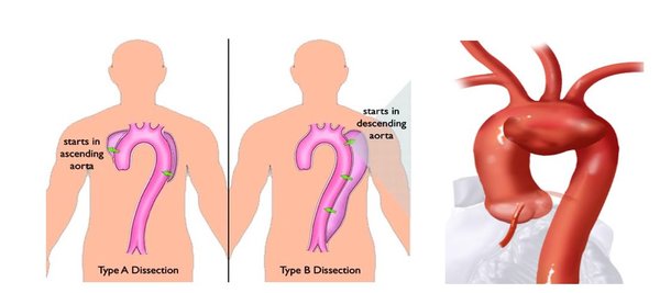 左图：主动脉A型 & B型夹层 右图：主动脉弓部瘤