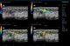 上图展示了乳腺浸润性导管癌的彩色多普勒血流图像与不同波长下光声融合图像的结果