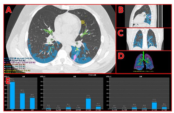 （上图为开发中的画面）新型冠状病毒肺炎患者的CT图像及分析结果