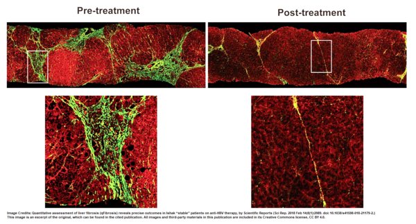 Figure 1: Stain-free images from HistoIndex’s AI-based digital pathology platform show a reduction of fibrous septa (in green) after treatment. After the images are produced, the platform generates data on the assessment of fibrosis parameters, which are crucial in determining treatment evaluation and modification.