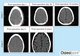 Post-surgery CT scans of two patients at various stages of the Osteoplug implantation recovery — in both cases, tissue ingrowth is observed to cover the burr hole sufficiently