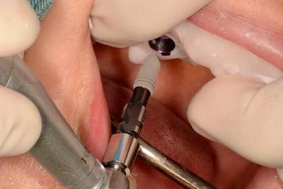 医生通过3D打印的外科导板精确控制种植牙植入位置、角度、深度