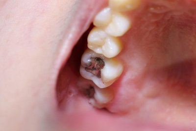 All silver fillings contain approximately 50% mercury.