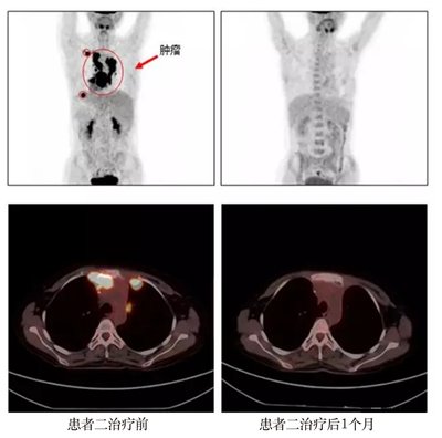 浙医一院淋巴瘤临床试验患者CAR-T治疗前后CT对比图