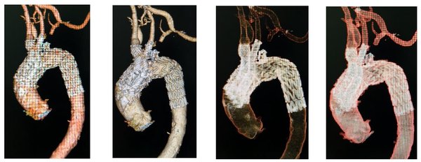 唯強醫療全球首例模塊內嵌主動脈弓覆膜支架臨床成功完成
