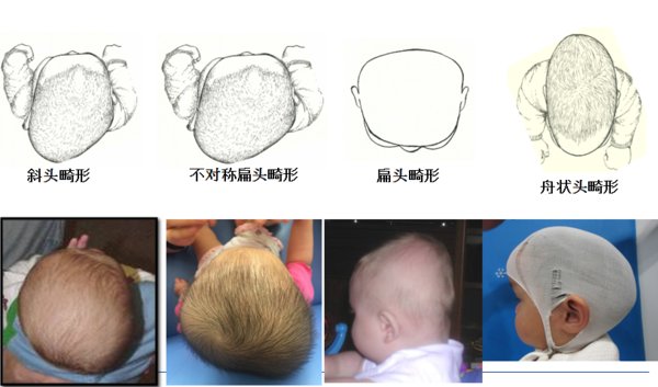 常见的头型异常包括：斜头畸形；不对称扁头畸形；扁头畸形以及舟状头畸形