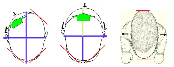 佩戴头型矫正器（简称头盔）的基本原则是为头骨生长提供路径