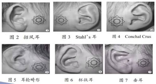 首都医疗爱育华妇儿医院与北京儿童医院合作推出新生儿耳廓矫正服务