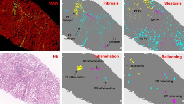 qFIBS is employed to automatically recognize the key features of NASH in various regions of the Central Vein (CV), Portal Tract (PT), and Perisinusoidal (PS) within the liver biopsies, before generating a fully quantified and consistent analysis of the images to determine the severity and monitor the changes in fibrosis, lobular inflammation, hepatocyte ballooning and steatosis, which are minute yet important. Picture Credits: © HistoIndex