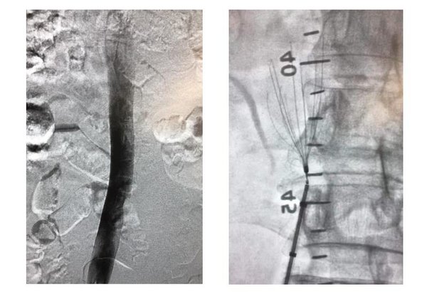 左图：置入滤器前下腔静脉造影 右图：下腔芭蕾滤器置入术中