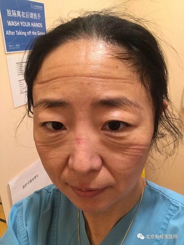 摘下口罩，张燕萍医生的脸上满是深深的压痕