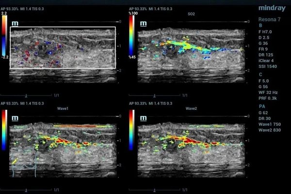 上图展示了乳腺浸润性导管癌的彩色多普勒血流图像与不同波长下光声融合图像的结果