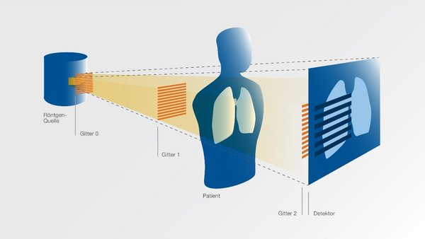 Low-dose radiographs could reveal typical lung changes