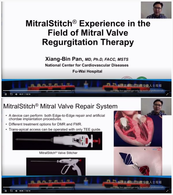 潘湘斌教授介绍MitralStitch®的器械特点、应用经验以及典型病例等