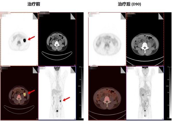 患者治療前后影像學(xué)檢查對比